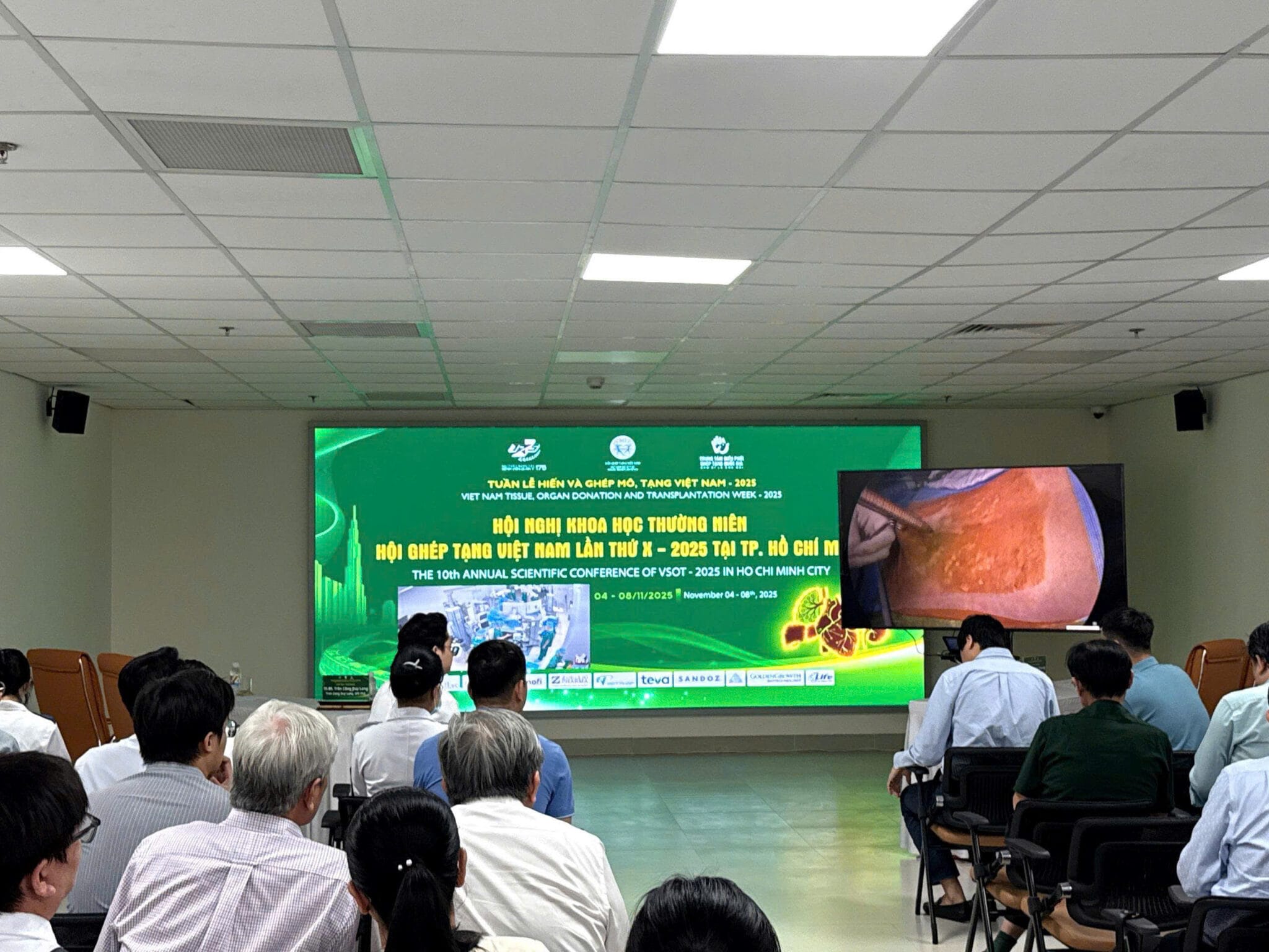 HAI PHẪU THUẬT NỘI SOI LẤY TẠNG GHÉP ĐƯỢC TIẾN HÀNH ĐỒNG THỜI TRONG CHƯƠNG TRÌNH PHẪU THUẬT THỊ PHẠM GHÉP THẬN, GHÉP GAN CỦA HỘI NGHỊ KHOA HỌC VSOT LẦN THỨ 10 – 2025 ĐƯỢC TỔ CHỨC TẠI BỆNH VIỆN QUÂN Y 175